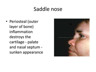 Saddle nose
• Periosteal (outer
layer of bone)
inflammation
destroys the
cartilage - palate
and nasal septum -
sunken appearance
 