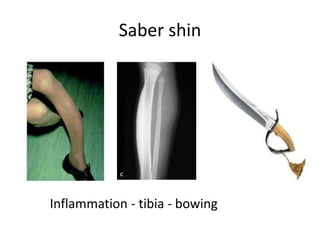 Saber shin
Inflammation - tibia - bowing
 