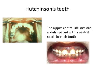 Hutchinson’s teeth
The upper central incisors are
widely spaced with a central
notch in each tooth
 