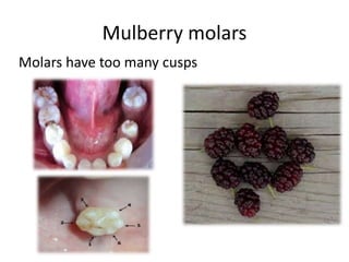 Mulberry molars
Molars have too many cusps
 