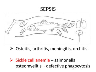 SEPSIS
 Osteitis, arthritis, meningitis, orchitis
 Sickle cell anemia – salmonella
osteomyelitis – defective phagocytosis
 