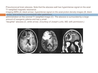 Pneumococcal brain abscess. Note that the abscess wall has hyperintense signal on the axial
T1-weighted magnetic resonance
imaging (MRI) (A, black arrow), hypointense signal on the axial proton density images (B, black
arrow), and enhances prominently after gadolinium
administration on the coronal T1-weighted image (C). The abscess is surrounded by a large
amount of vasogenic edema and has a small
“daughter” abscess (C, white arrow). (Courtesy of Joseph Lurito, MD; with permission.)
 