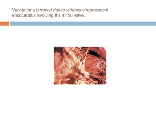 Vegetations (arrows) due to viridans streptococcal
endocarditis involving the mitral valve.
 