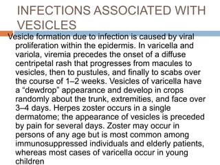 INFECTIONS ASSOCIATED WITH
VESICLES
Vesicle formation due to infection is caused by viral
proliferation within the epidermis. In varicella and
variola, viremia precedes the onset of a diffuse
centripetal rash that progresses from macules to
vesicles, then to pustules, and finally to scabs over
the course of 1–2 weeks. Vesicles of varicella have
a “dewdrop” appearance and develop in crops
randomly about the trunk, extremities, and face over
3–4 days. Herpes zoster occurs in a single
dermatome; the appearance of vesicles is preceded
by pain for several days. Zoster may occur in
persons of any age but is most common among
immunosuppressed individuals and elderly patients,
whereas most cases of varicella occur in young
children
 