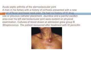 Acute septic arthritis of the sternoclavicular joint.
A man in his forties with a history of cirrhosis presented with a new
onset of fever and lower neck pain. He had no history of IV drug
use or previous catheter placement. Jaundice and a painful swollen
area over his left sternoclavicular joint were evident on physical
examination. Cultures of blood drawn at admission grew group B
Streptococcus. The patient recovered after treatment with IV penicillin
 