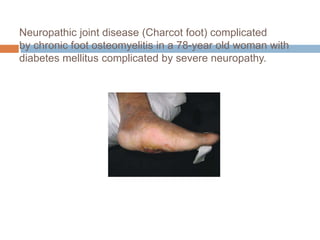 Neuropathic joint disease (Charcot foot) complicated
by chronic foot osteomyelitis in a 78-year old woman with
diabetes mellitus complicated by severe neuropathy.
 
