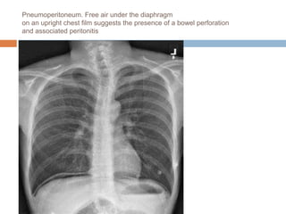 Pneumoperitoneum. Free air under the diaphragm
on an upright chest film suggests the presence of a bowel perforation
and associated peritonitis
 