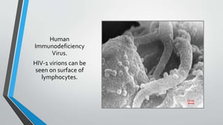 Human 
Immunodeficiency 
Virus. 
HIV-1 virions can be 
seen on surface of 
lymphocytes. 
 