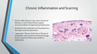 Chronic Inflammation and Scarring 
• Chronic HBV infection may cause cirrhosis of 
the liver, in which dense fibrous septae 
surround nodules of regenerating hepatocytes. 
• Sometimes the exuberant scarring response is 
the major cause of dysfunction. 
• “pipe-stem” fibrosis of the liver or fibrosis of 
the bladder wall caused by schistosomal eggs 
or the constrictive fibrous pericarditis in 
tuberculosis 
 