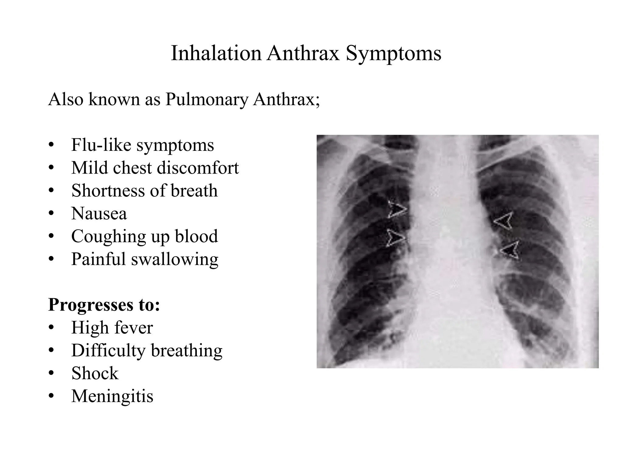 Inhalation Anthrax Symptoms
Also known as Pulmonary Anthrax;
• Flu-like symptoms
• Mild chest discomfort
• Shortness of breath
• Nausea
• Coughing up blood
• Painful swallowing
Progresses to:
• High fever
• Difficulty breathing
• Shock
• Meningitis
 