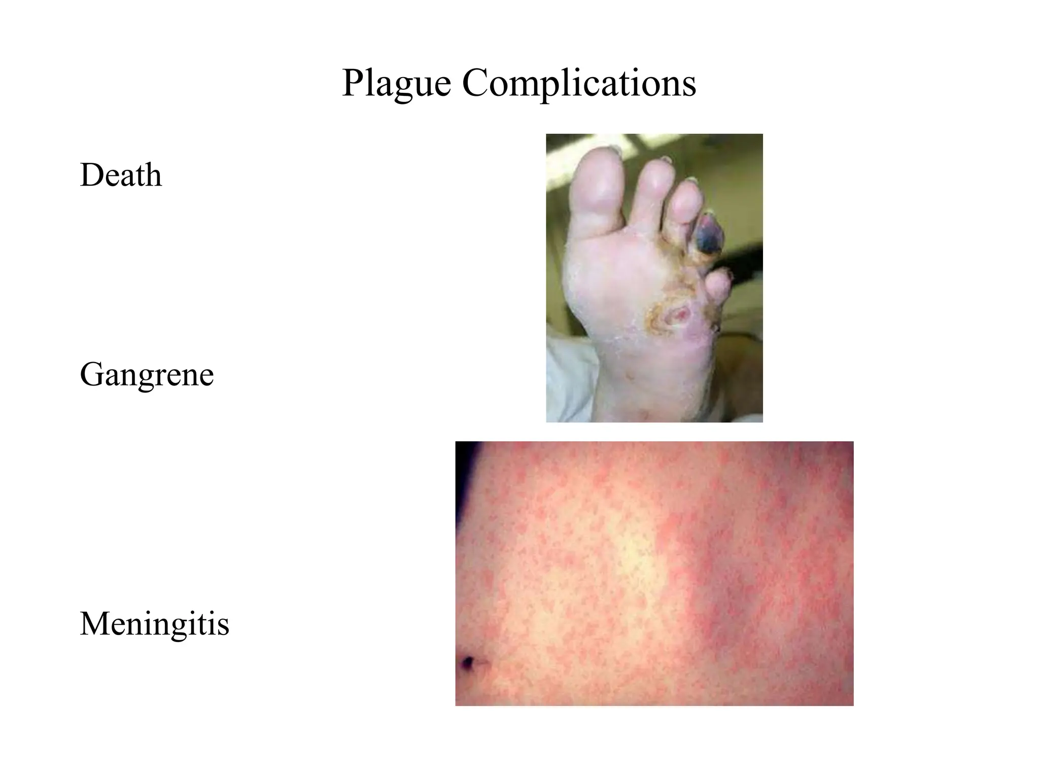 Plague Complications
Death
Gangrene
Meningitis
 
