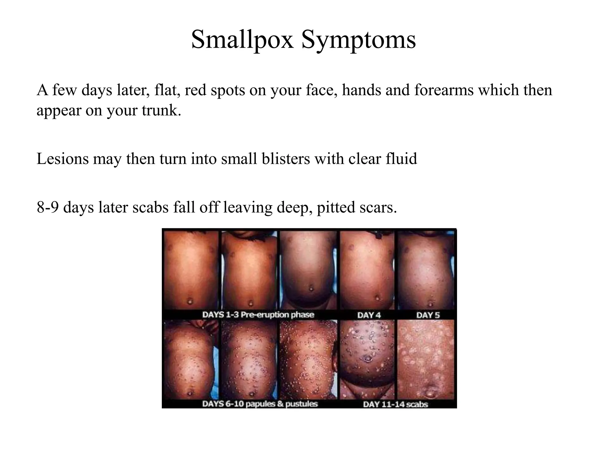 Smallpox Symptoms
A few days later, flat, red spots on your face, hands and forearms which then
appear on your trunk.
Lesions may then turn into small blisters with clear fluid
8-9 days later scabs fall off leaving deep, pitted scars.
 