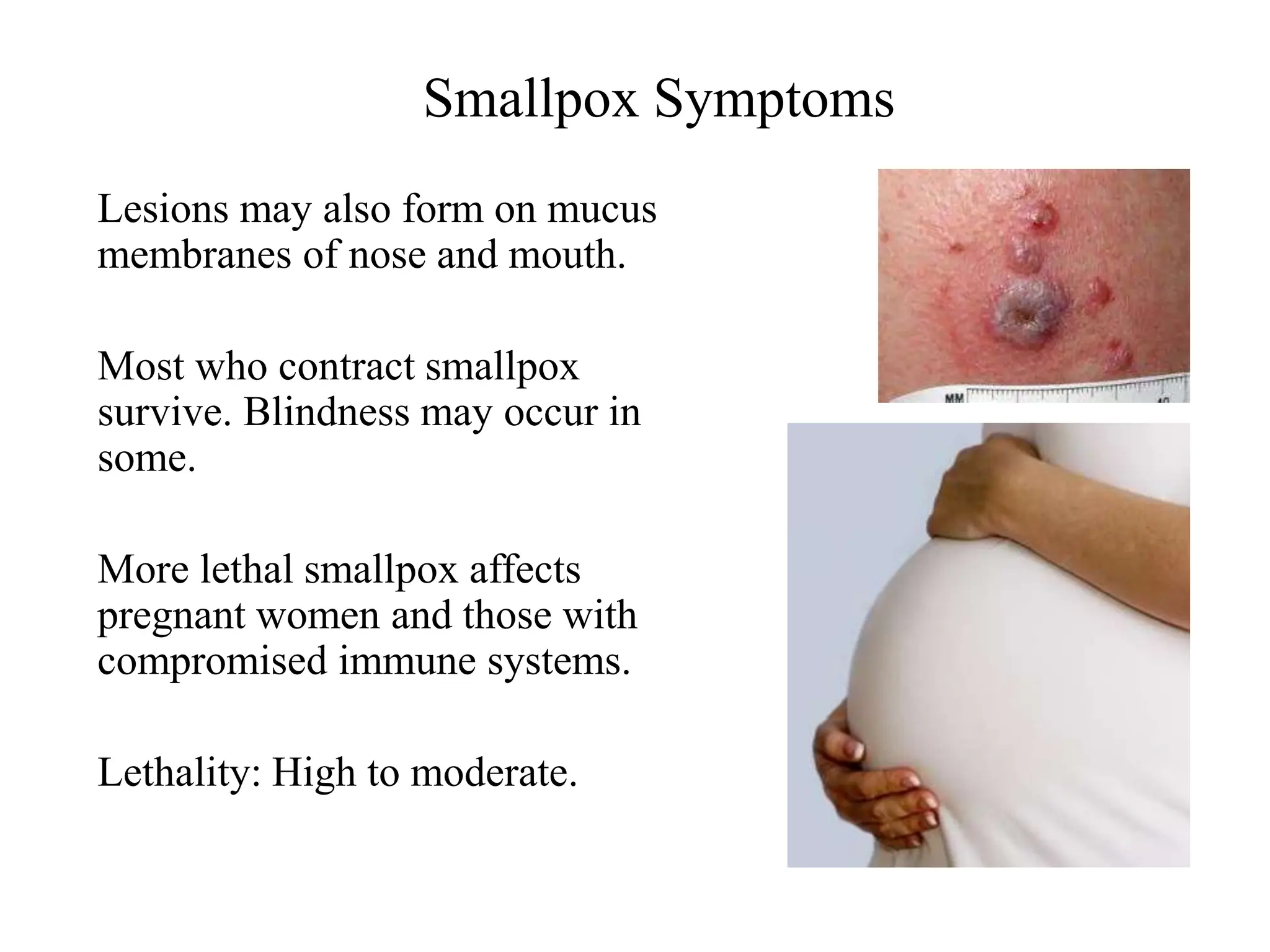 Smallpox Symptoms
Lesions may also form on mucus
membranes of nose and mouth.
Most who contract smallpox
survive. Blindness may occur in
some.
More lethal smallpox affects
pregnant women and those with
compromised immune systems.
Lethality: High to moderate.
 