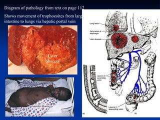 Liver abscess Diagram of pathology from text on page 112 Shows movement of trophozoites from large intestine to lungs via hepatic portal vein 