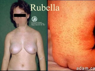 Rubella 