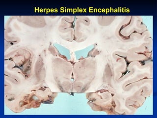Herpes Simplex Encephalitis 