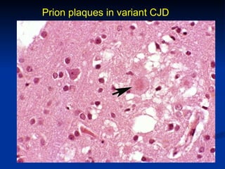 Prion plaques in variant CJD 