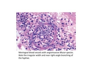 Meningeal blood vessels with angioinvasive Mucor species.
Note the irregular width and near right-angle branching of
the hyphae.
 