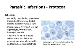 Parasitic Infections - Protozoa
Babesiosis
• caused by malaria-like protozoans
transmitted from white-footed
mice to humans by Ixodes ticks.
• Babesia cause fever and, through
erythrocyte parasitization,
hemolytic anemia.
• • Babesia resemble malaria
schizonts but lack hemozoin
pigment, are more pleomorphic,
and form characteristic tetrads.
Erythrocytes with Babesia, including the
distinctive Maltese cross form.
 