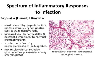 Spectrum of Inflammatory Responses
to Infection
Suppurative (Purulent) Inflammation
• usually caused by pyogenic bacteria,
mostly extracellular gram-positive
cocci & gram- negative rods.
• Increased vascular permeability &
neutrophil recruitment by bacterial
chemoattractants.
• • Lesions vary from tiny
microabscesses to entire lung lobes.
• may resolve without sequelae
(pneumococcal pneumonia) or may
scar (Klebsiella).
Pneumococcal pneumonia with extensive
neutrophilic infiltrate.
 