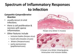 Spectrum of Inflammatory Responses
to Infection
Cytopathic-Cytoproliferative
Reaction
• usually occurs in viral
Infections.
• there is cell proliferation &
necrosis with sparse
inflammation.
• Other features include
– inclusion bodies (herpes virus)
– fused cells (measles viruses)
– blisters (herpesviruses)
– warty excrescences
(papillomaviruses).
A herpes virus blister showing glassy
intranuclear viral inclusion bodies.
Herpes virus blister in mucosa
 