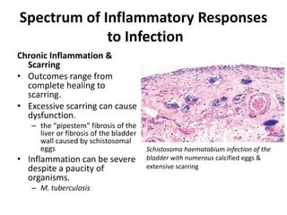 Spectrum of Inflammatory Responses
to Infection
Chronic Inflammation &
Scarring
• Outcomes range from
complete healing to
scarring.
• Excessive scarring can cause
dysfunction.
– the “pipestem” fibrosis of the
liver or fibrosis of the bladder
wall caused by schistosomal
eggs
• Inflammation can be severe
despite a paucity of
organisms.
– M. tuberculosis
Schistosoma haematobium infection of the
bladder with numerous calcified eggs &
extensive scarring
 