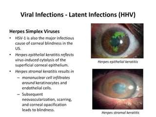 Viral Infections - Latent Infections (HHV)
Herpes Simplex Viruses
• HSV-1 is also the major infectious
cause of corneal blindness in the
US.
• Herpes epithelial keratitis reflects
virus-induced cytolysis of the
superficial corneal epithelium.
• Herpes stromal keratitis results in
– mononuclear cell infiltrates
around keratinocytes and
endothelial cells.
– Subsequent
neovascularization, scarring,
and corneal opacification
leads to blindness.
Herpes epithelial keratitis
Herpes stromal keratitis
 