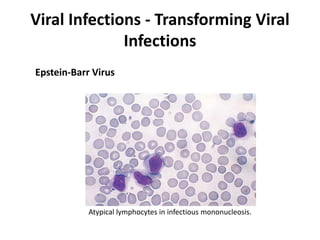 Viral Infections - Transforming Viral
Infections
Atypical lymphocytes in infectious mononucleosis.
Epstein-Barr Virus
 