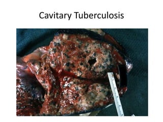 Cavitary Tuberculosis
 