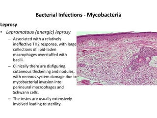 Bacterial Infections - Mycobacteria
Leprosy
• Lepromatous (anergic) leprosy
– Associated with a relatively
ineffective TH2 response, with large
collections of lipid-laden
macrophages overstuffed with
bacilli.
– Clinically there are disfiguring
cutaneous thickening and nodules,
with nervous system damage due to
mycobacterial invasion into
perineural macrophages and
Schwann cells.
– The testes are usually extensively
involved leading to sterility.
 