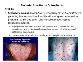 Bacterial Infections - Spirochetes
Syphilis
• Secondary syphilis occurs 2 to 10 weeks later in 75% of untreated
patients, due to spread and proliferation of spirochetes in skin
(including palms and soles) and mucocutaneous tissues
(especially mouth).
– Superficial lesions with erosions are painless and contain infectious
spirochetes. Mucocutaneous lesions show plasma cell infiltrates and
obliterative endarteritis.
– Lymphadenopathy, mild fever, malaise, and weight loss are common.
 