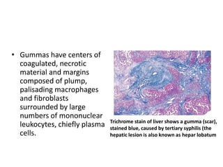 • Gummas have centers of
coagulated, necrotic
material and margins
composed of plump,
palisading macrophages
and fibroblasts
surrounded by large
numbers of mononuclear
leukocytes, chiefly plasma
cells.
Trichrome stain of liver shows a gumma (scar),
stained blue, caused by tertiary syphilis (the
hepatic lesion is also known as hepar lobatum
 
