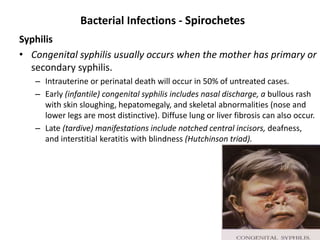 Bacterial Infections - Spirochetes
Syphilis
• Congenital syphilis usually occurs when the mother has primary or
secondary syphilis.
– Intrauterine or perinatal death will occur in 50% of untreated cases.
– Early (infantile) congenital syphilis includes nasal discharge, a bullous rash
with skin sloughing, hepatomegaly, and skeletal abnormalities (nose and
lower legs are most distinctive). Diffuse lung or liver fibrosis can also occur.
– Late (tardive) manifestations include notched central incisors, deafness,
and interstitial keratitis with blindness (Hutchinson triad).
 
