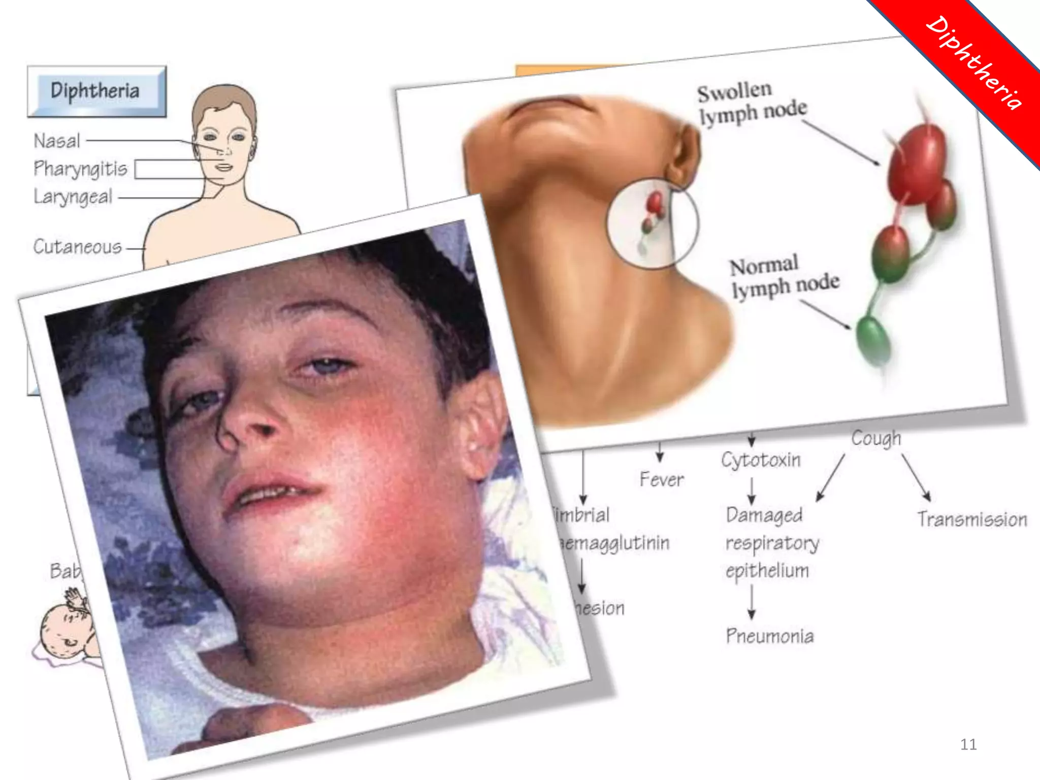 (Infectious diseases) diphtheria in pashto language by dr. kalimullah ...