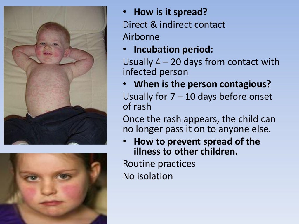 Infectious diseases in childhood