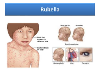 Infectious diseases in children | PPTX
