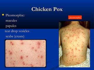 Infectious disease skin rash | PPT