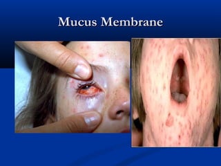 Mucusum Rash Infectious disease skin rash | PPT