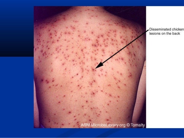 acute disseminated encephalitis in adults acute disseminated encephalitis in adults