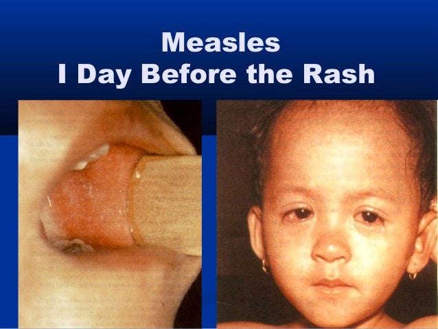 Infectious disease skin rash
