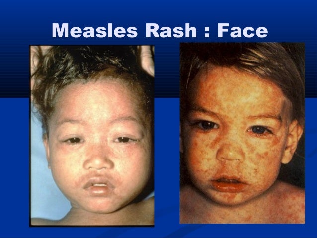 wallpapers Mononucleosis Rash Face infectious disease skin rash