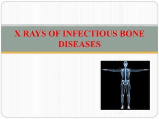 X RAYS OF INFECTIOUS BONE
DISEASES
 