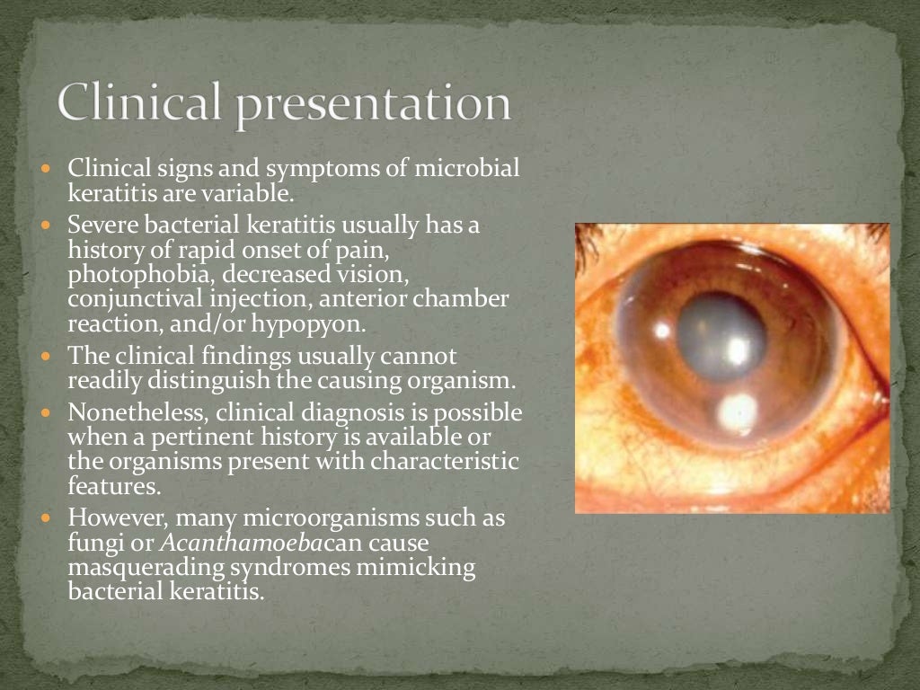 Infectious Keratitis