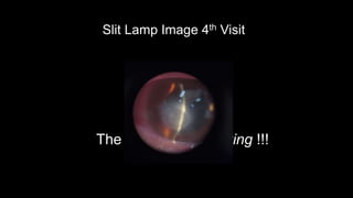Slit Lamp Image 4th Visit
However..
The cornea was melting !!!
 