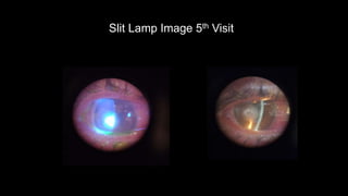Slit Lamp Image 5th Visit
 