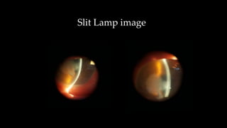 Slit Lamp image
 