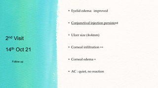 2nd Visit
14th Oct 21
Follow up
• Eyelid edema: improved
• Conjunctival injection persistent
• Ulcer size (4x4mm)
• Corneal infiltration ++
• Corneal edema +
• AC : quiet, no reaction
 