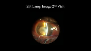 Slit Lamp Image 2nd Visit
 