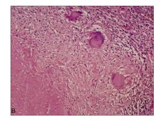 Introduction to Infectious Diseases and Bacterial Infections | PPTX