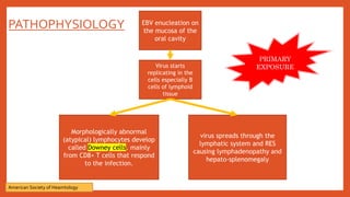 PATHOPHYSIOLOGY EBV enucleation on
the mucosa of the
oral cavity
Virus starts
replicating in the
cells especially B
cells of lymphoid
tissue
virus spreads through the
lymphatic system and RES
causing lymphadenopathy and
hepato-splenomegaly
Morphologically abnormal
(atypical) lymphocytes develop
called Downey cells. mainly
from CD8+ T cells that respond
to the infection.
PRIMARY
EXPOSURE
American Society of Heamtology
 
